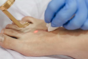 Лазерное лечение рубцов и шрамов